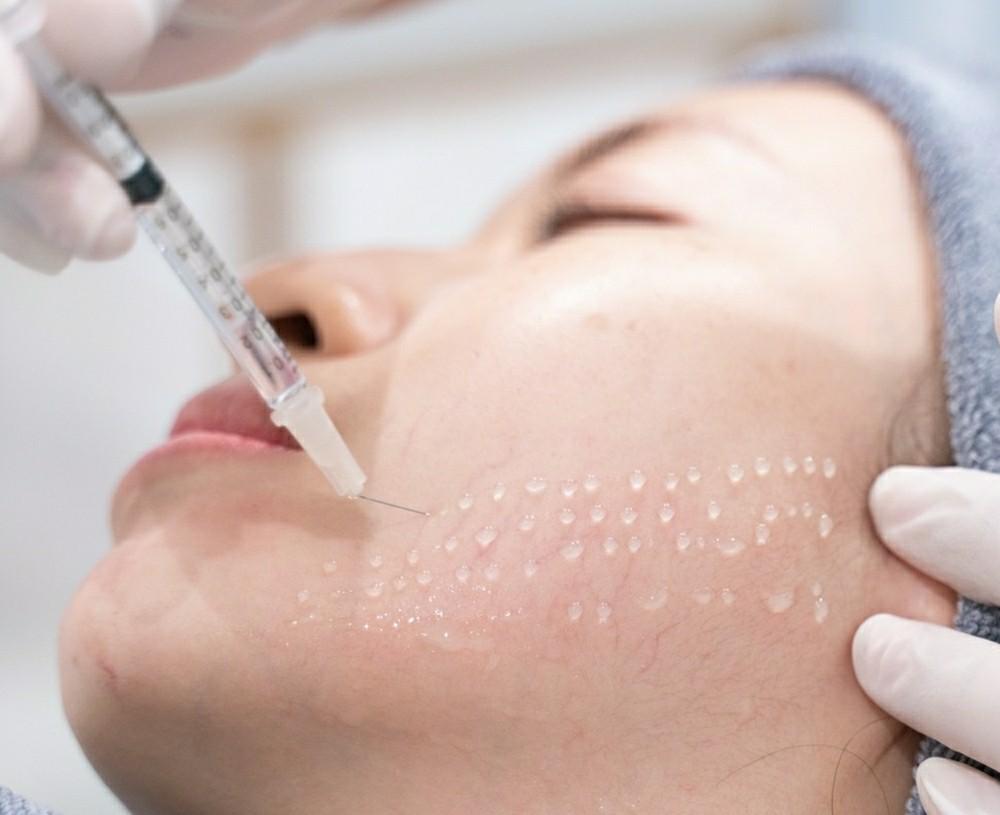 Tiêm Glutathione và Vitamin C vào tĩnh mạch phân bổ hoạt chất qua máu, ức chế mạnh melanin và thải độc, giúp dưỡng trắng toàn thân từ bên trong.
