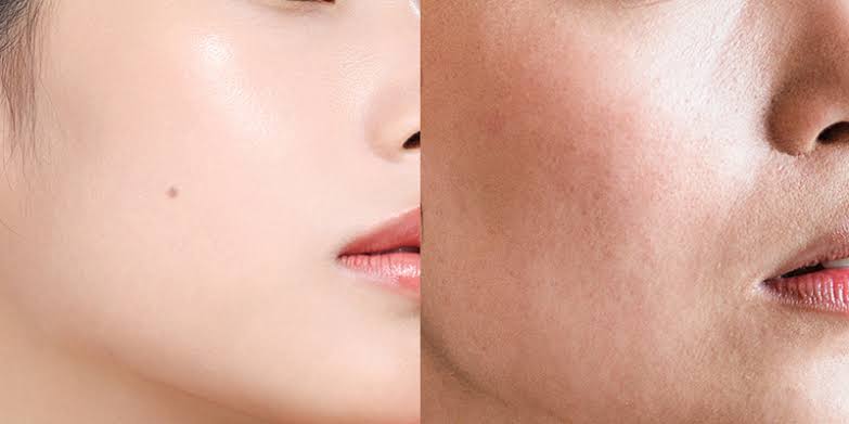Sạm da nhẹ chỉ mất khoảng 2–4 tuần để phục hồi tone trắng nhờ lượng melanin nằm ở bề mặt biểu bì, dễ dàng đào thải nhanh khi dưỡng ẩm, tẩy da chết dịu nhẹ và chống nắng kỹ.