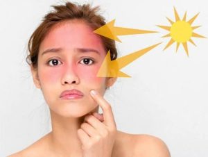 Da mặt bị cháy nắng làm sao để trắng lại nhanh nhất