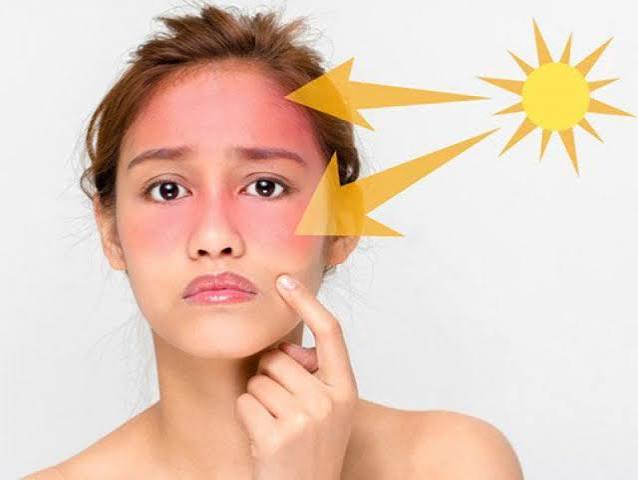 Da mặt bị cháy nắng làm sao để trắng lại nhanh nhất