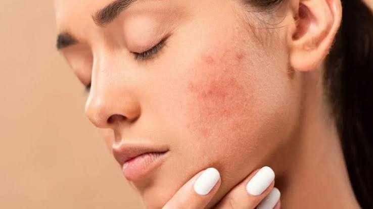 Da mặt mỏng, nhạy cảm và tiếp xúc nắng trực tiếp nên dễ bỏng rát, tổn thương sâu hơn da cơ thể, nhưng cũng có tốc độ phục hồi nhanh hơn nếu chăm sóc chuẩn.